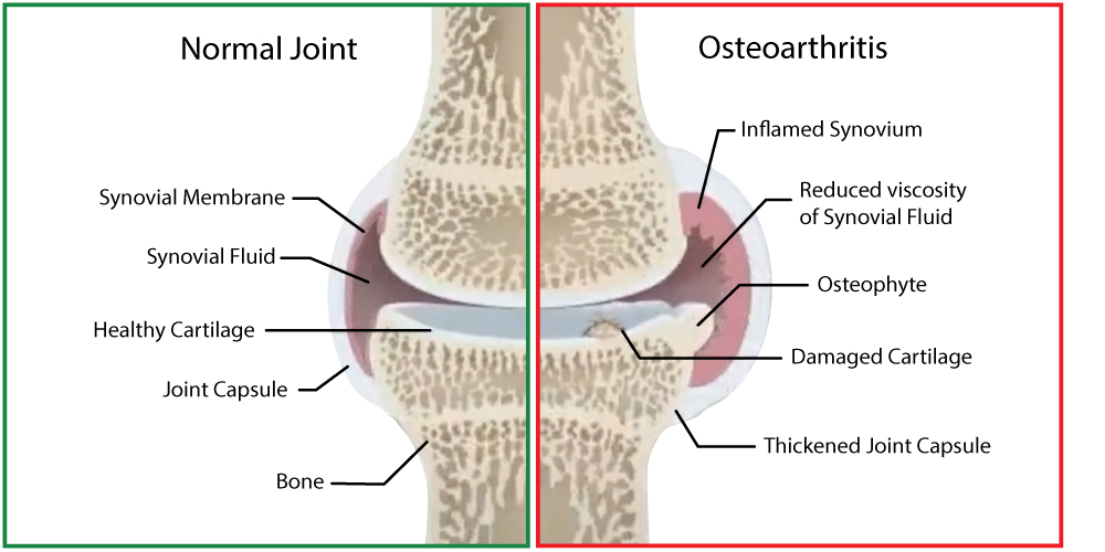Osteoarthritis can lead to joint displasia
